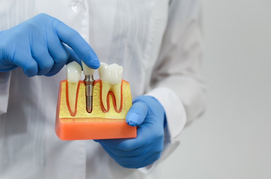 البورد الأمريكي في زراعة الأسنان